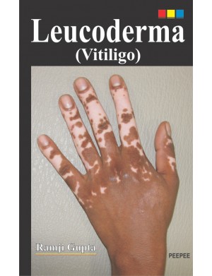 Leucoderma (Vitiligo)