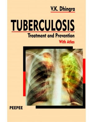 Tuberculosis: Treatment & Prevention 2e