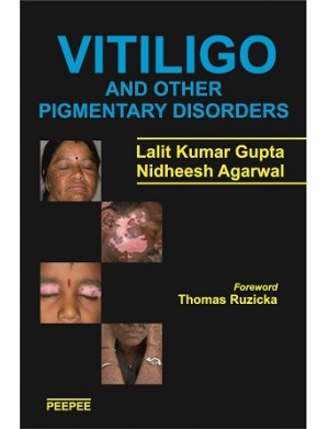 Vitiligo and Other Pigmentary Disorders